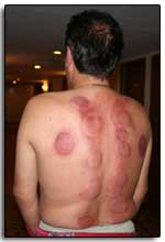 michel a des traces de ventouses sur le dos